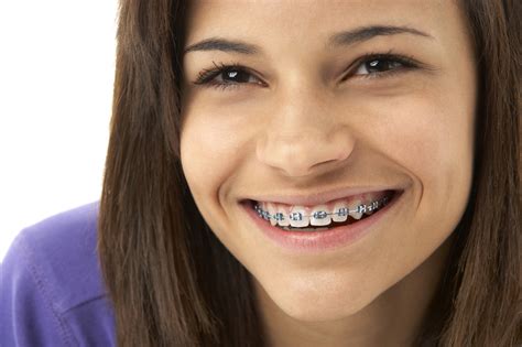 How To Keep Your Teeth White With Braces | Thomas Orthodontics