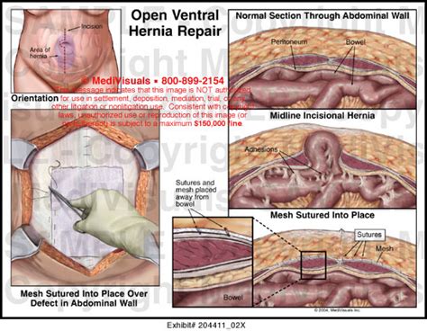 Medivisuals Open Ventral Hernia Repair Medical Illustration