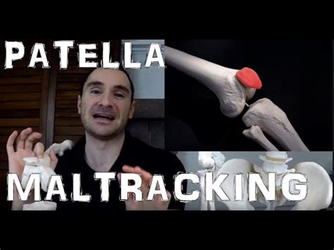 Help Fix Patellar Maltracking From A Tight IT Band With This Tip! - YouTube