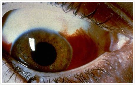 Blood in White of Eye Detroit | Subconjunctival Hemorrhage Pontiac ...