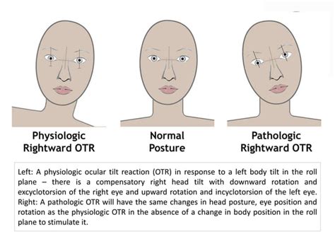 Ocular tilt reaction and skew deviation