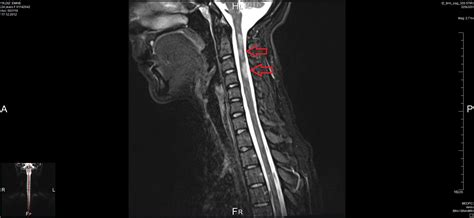 Multiple Sclerosis With Dysesthesia Symptoms - Selçuk Tıp Dergisi