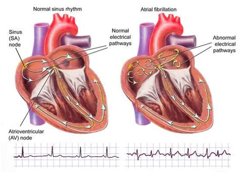 La fibrilación auricular, la arritmia cardíaca más frecuente, no controlada multiplica por cinco ...