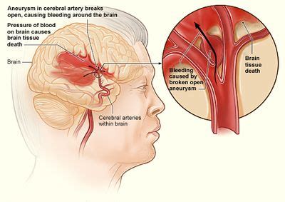 Intraocular hemorrhages intracranial pressure subarachnoid hemorrhage. Medical search. Images