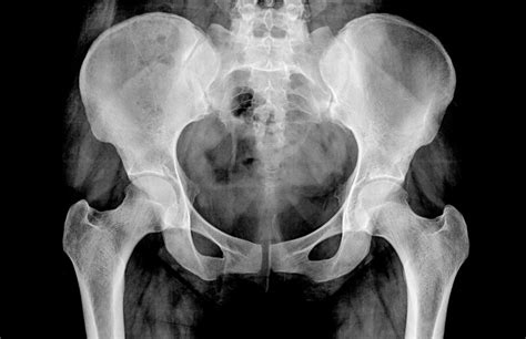 Psoas injection: who benefits? - Sport Doctor London