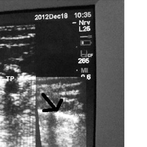 Ultrasound-guided paravertebral block in an 'out-of-plane' technique. | Download Scientific Diagram