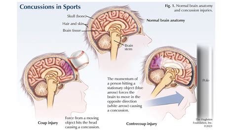 Concussions in Sports - Hughston Clinic