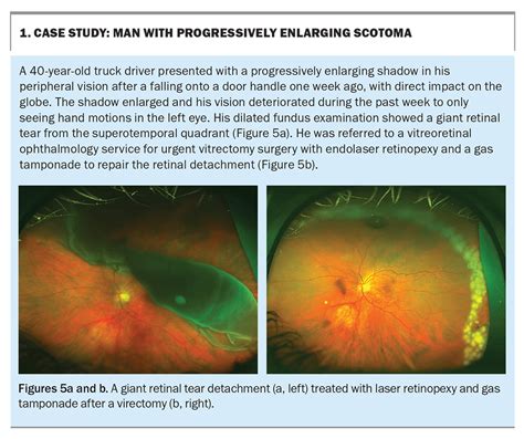 Flashes and floaters: symptoms not to be ignored | Medicine Today