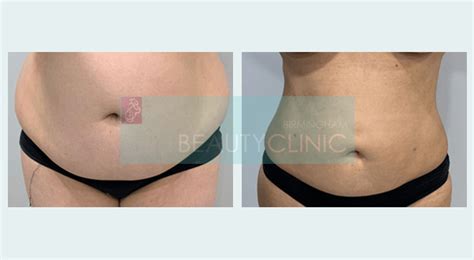 Stomach Liposuction Before and After | Birmingham UK