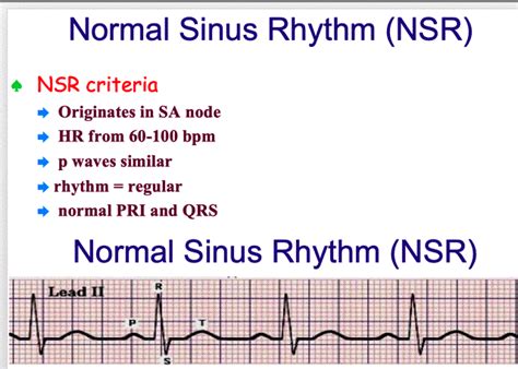 Sinus Rhythms