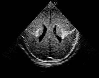 Ultrasound Neonatal Head Phantom (Normal Type)