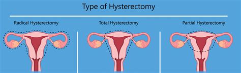 Hysterectomy Scar