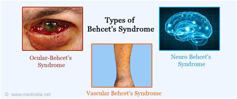 types-of-behcets-syndrome.jpg