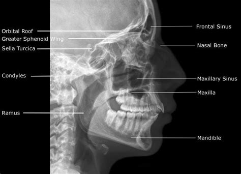 Radiographic Anatomy of Facial Bones » Free PDF EPUB Medical Books ...