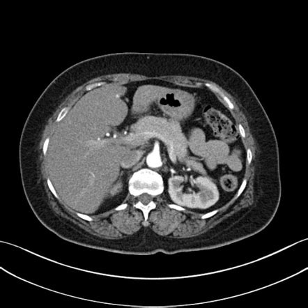 CT pancreas (protocol) | Radiology Reference Article | Radiopaedia.org