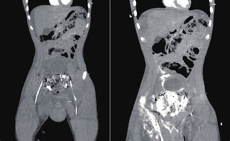 Ct Thorax Abdomen Pelvis With Contrast Scan