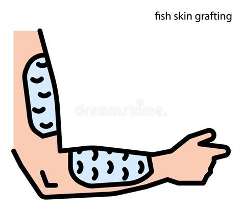 Fish Skin Grafting for Wound Healing Stock Illustration - Illustration ...