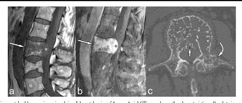 A systematic approach to vertebral hemangioma | Semantic Scholar