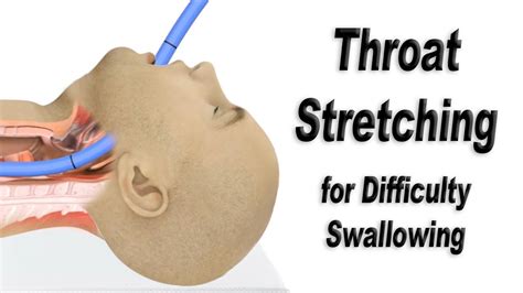 Esophageal Dilation or Throat Stretching for Difficulty Swallowing - YouTube