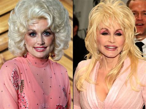 Dolly Parton Plastic Surgery Before and After Breast Implants, Facelift, Eyelid Surgery