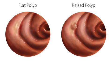 Flat polyps: Why finding them requires skill | UCI Health | Orange County, CA