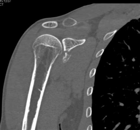 Glenoid Fracture - Musculoskeletal Case Studies - CTisus CT Scanning