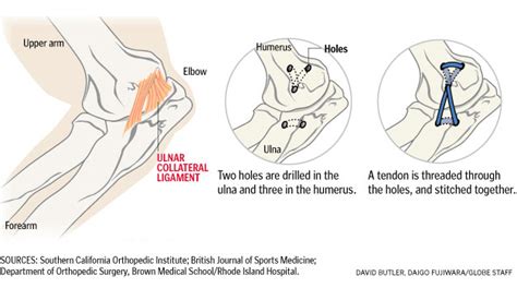 Tommy John Elbow Procedures | Dr Skedros Orthopaedics