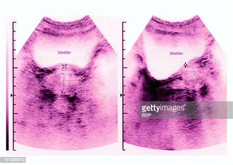 49 Bladder Ultrasound Stock Photos, High-Res Pictures, and Images ...