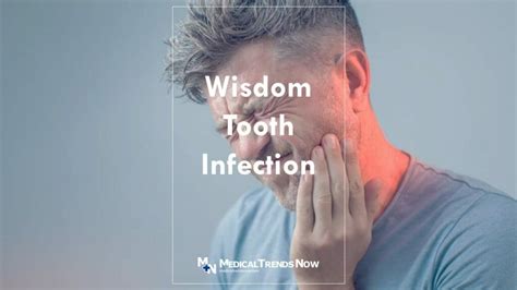 What Causes a Wisdom Tooth Infection and How To Treat Pericoronitis? – Medical Trends Now