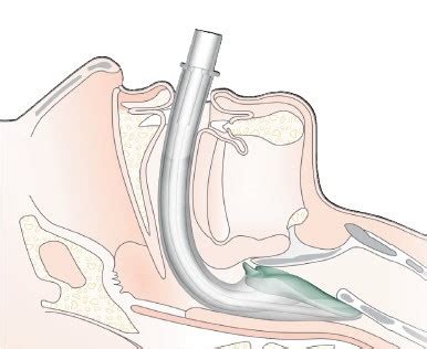 I-gel Supraglottic Airway - Protocopedia