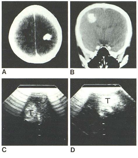 Figure 4 from Localization and Ventricular Shunt Placement ...