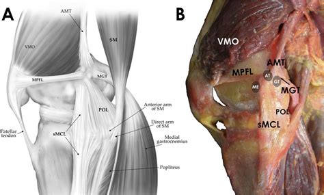 Vastus Medialis Obliquus