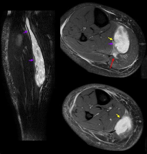 Not the Plantaris – Keys to Better Diagnosis of Calf Strain Injuries | Radsource