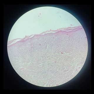 Typical Wickham striae in the posterior part of the buccal mucosa ...