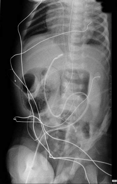 Hirschsprung's disease other imaging findings - wikidoc