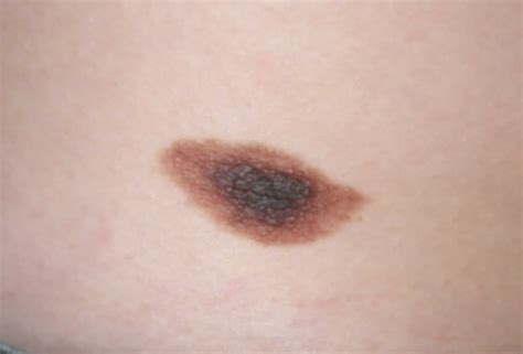 Congenital nevus & congenital melanocytic nevus causes, symptoms ...