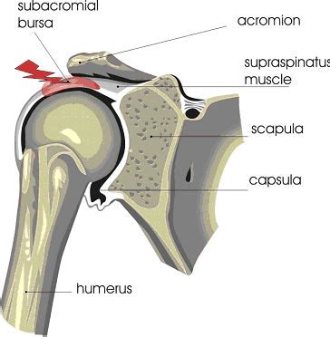 Shoulder Surgery Scar Tissue - Facts And Information For Patients