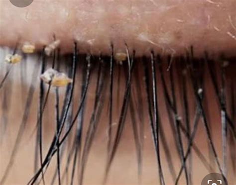 Don’t let the bugs bug you: Learn how to prevent eyelash extension lice. | Eyelash extensions ...