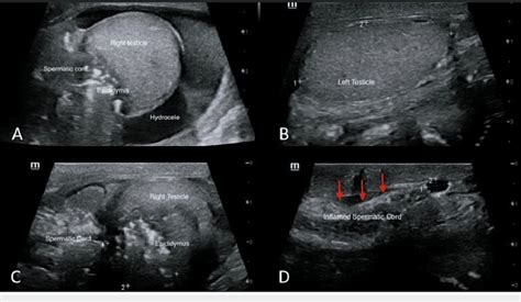 (A) Ultrasound images showing irregular right testis, edematous... | Download Scientific Diagram