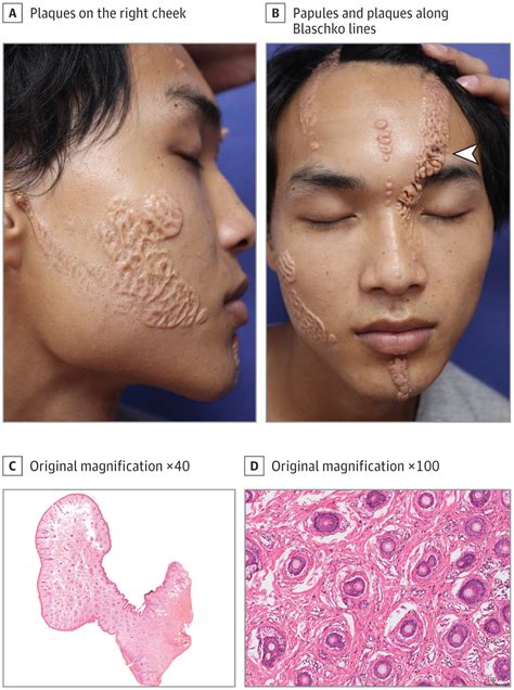 Multiple Craniofacial Nodules and Plaques Distributed Bilaterally Along ...