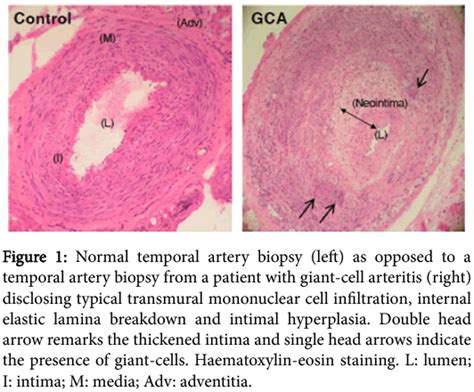 Giant-Cell Arteritis: Immunopathogenic Mechanisms Involved in Vascular ...