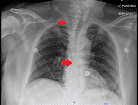 Central Venous Catheter Placement Gone Awry: A Case Report of Right Internal Jugular Central ...