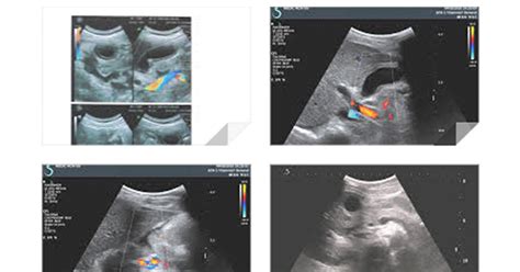 VIETNAMESE MEDIC ULTRASOUND: CASE 363: MURPHY'S SIGN POSITIVE, Dr PHAN ...