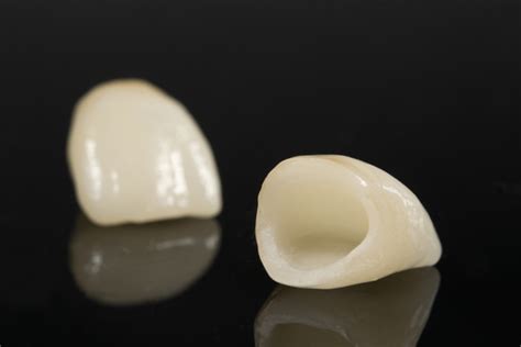 All Ceramic Crowns and Bridges | Dr. Steve Tschach