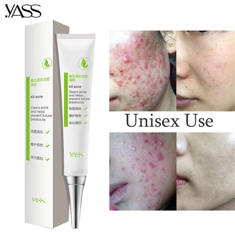 Aliexpress.com : Buy Herbal Acne Cream Anti Pimple Spot Acne Scars ...