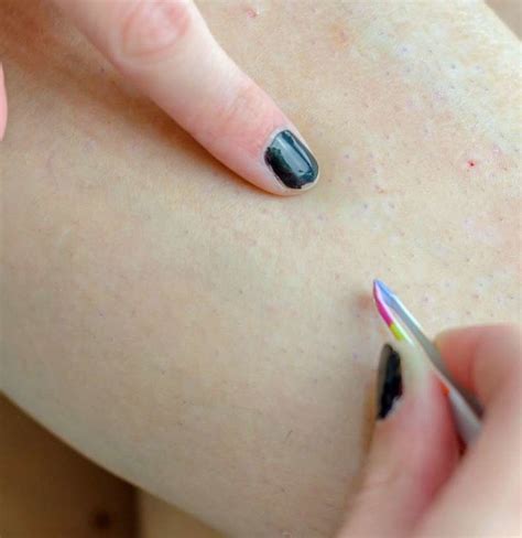 Ingrown hair on legs: Removal and prevention