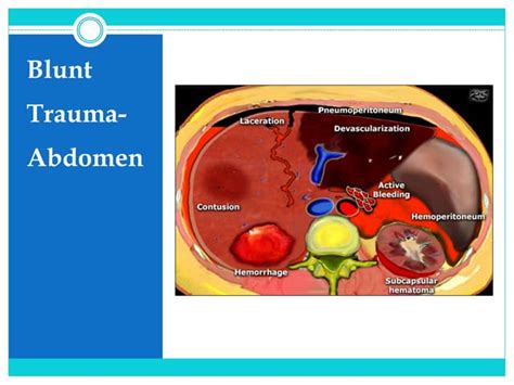 Blunt trauma abdomen | PPT