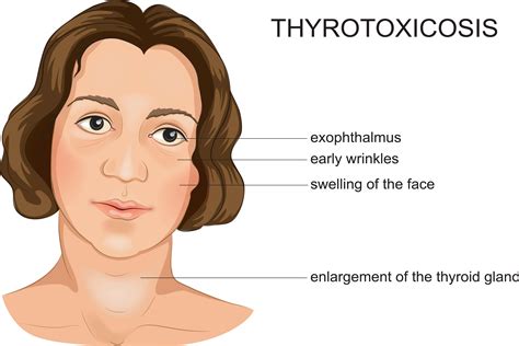 CME Activity | Thyrotoxicosis | MDs & PAs