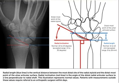 Buckle (Greenstick) Fracture of the Distal Radius - Sports Medicine Review