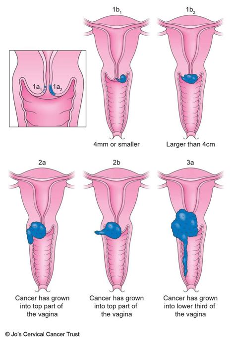 Pin on "Squamous cell carcinoma of cervix"